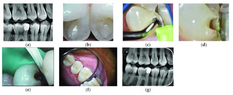 slot cavity|Slot cavity preparation on a distal carious lesion of an .